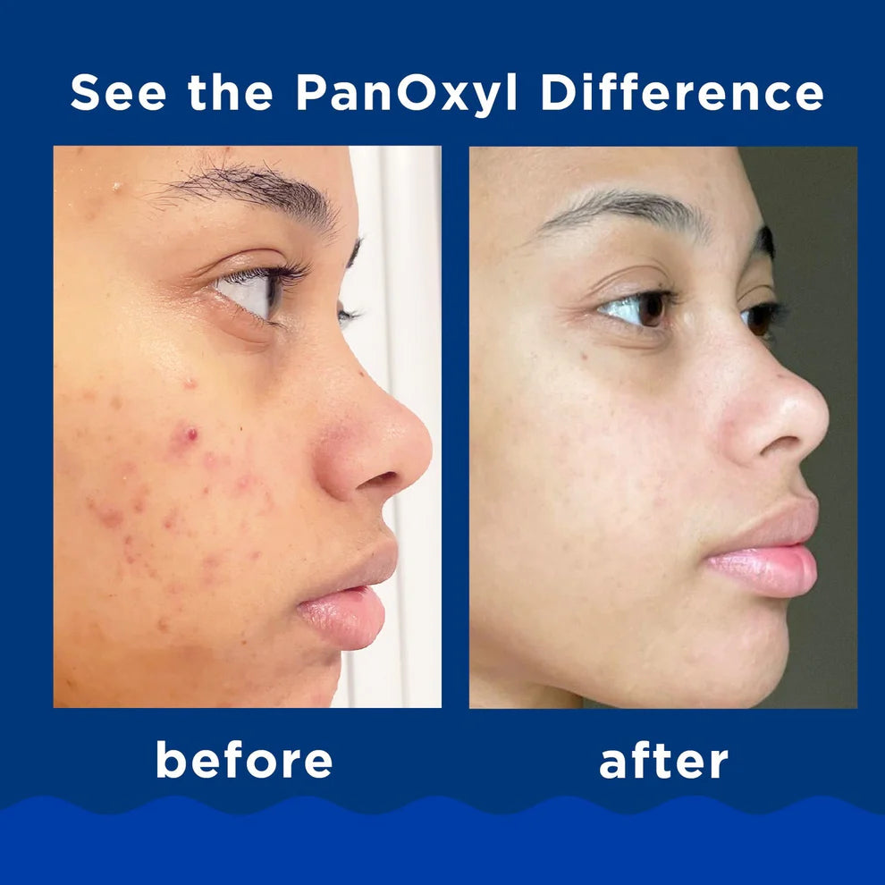PanOxyl Maximum Strength Acne Foaming Wash 10% Benzoyl Peroxide 156g
