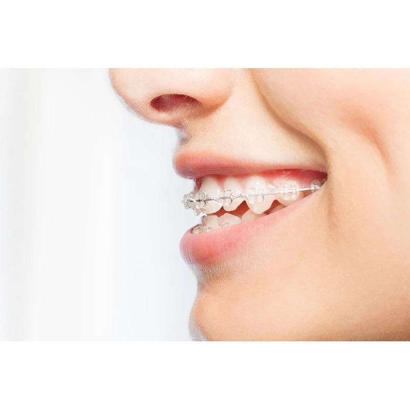 Optimal Cleo-Dent Orthodontic Wax – Clear, Comfort & Protection